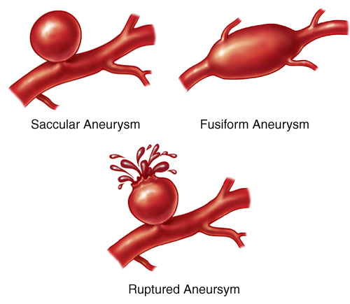 Different forms of aneurysms.